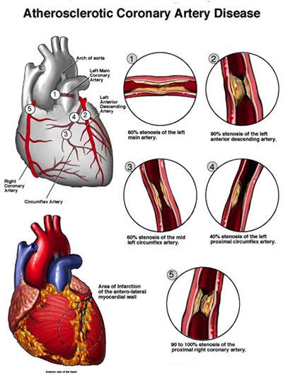 Coronary Artery Disease; atherosclerosis