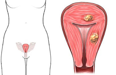 Fibroids in the uterus