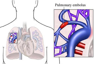 Pulmonary Embolus